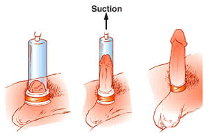 Làm to và kéo dài dương vật bằng máy tập Penis